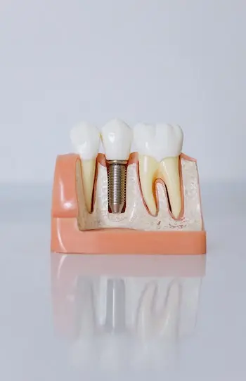 Illustration d'un implant dentaire en positionnement
